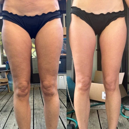 Voruva™ - Cellulite & Circulation Boost Massager